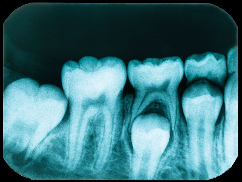 xray image of child's teeth